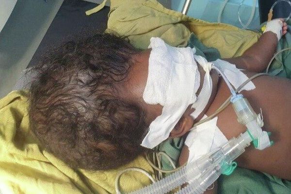 ቅዱስ ጴጥሮስ ሆስፒታል ከውስብስብ የአንጎል አፈጣጠር ችግር ጋር ለተወለደች ሕጻን የተሳካ ቀዶ ሕክምና ማድረጉን አስታወቀ ቅዱስ ጴጥሮስ ሆስፒታል ከውስብስብ የአንጎል አፈጣጠር ችግር ጋር ለተወለደች ሕጻን የተሳካ ቀዶ ሕክምና ማድረጉን አስታወቀ - Sputnik አፍሪካ